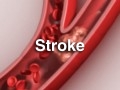 Stroke